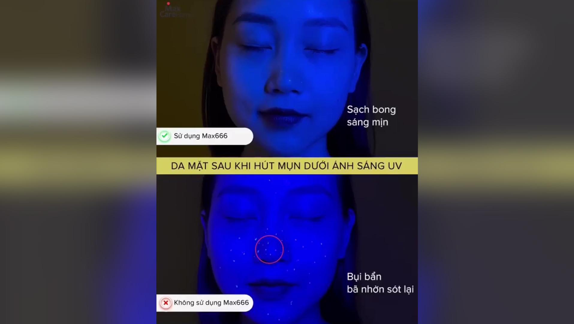 Hút Cực Mạnh Sạch Bay Mụn Đầu Đen Cùng Máy Hút Mụn Max666