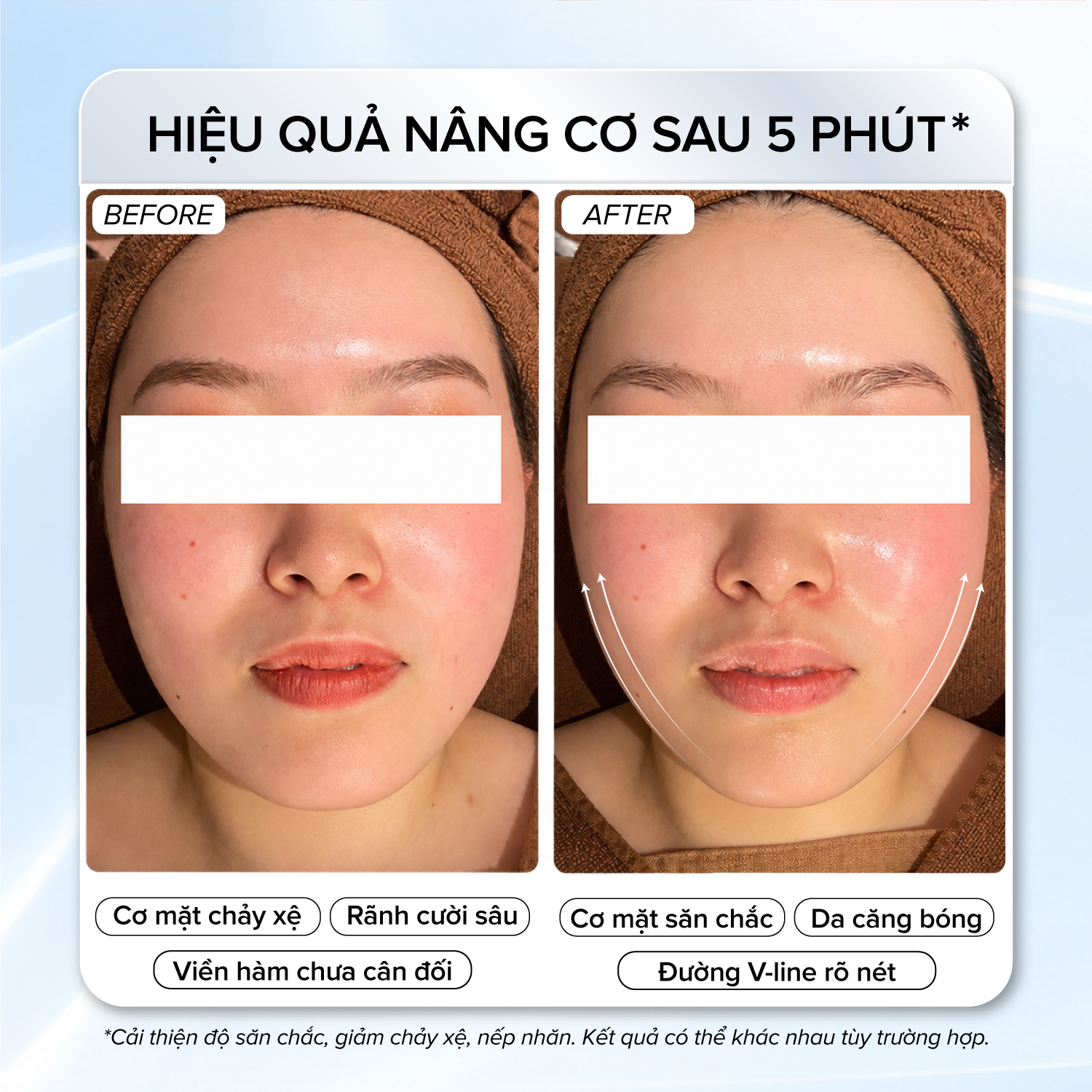 Hiệu quả của trí nhớ cơ mặt Memory Effect giúp viền hàm thon gọn thấy rõ sau lộ trình.