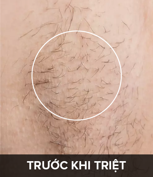 Trước khi triệt